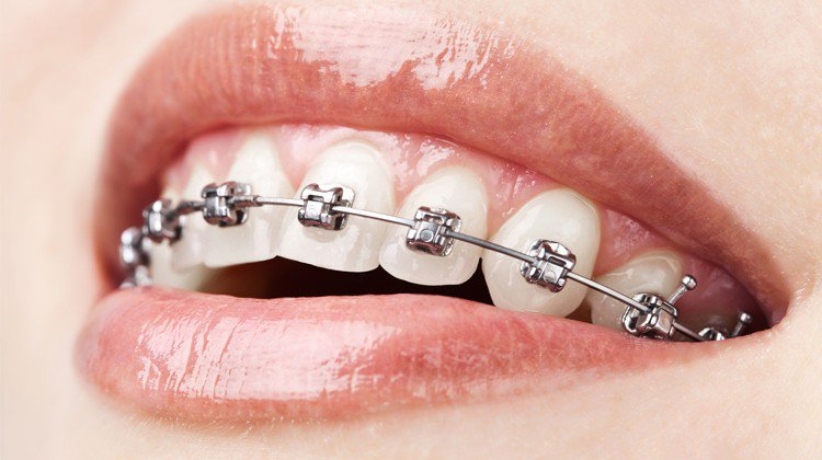 Vì sao niềng răng mắc cài kim loại vẫn được ưa chuộng? | Vinmec