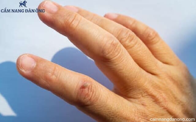 Vết sẹo trên ngón trỏ